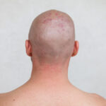 Man’s shaved head with diseased skin, acne and eczema